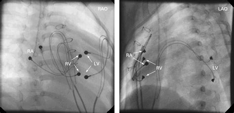 lv epicardial lead placement|invasive epicardial lead placement.